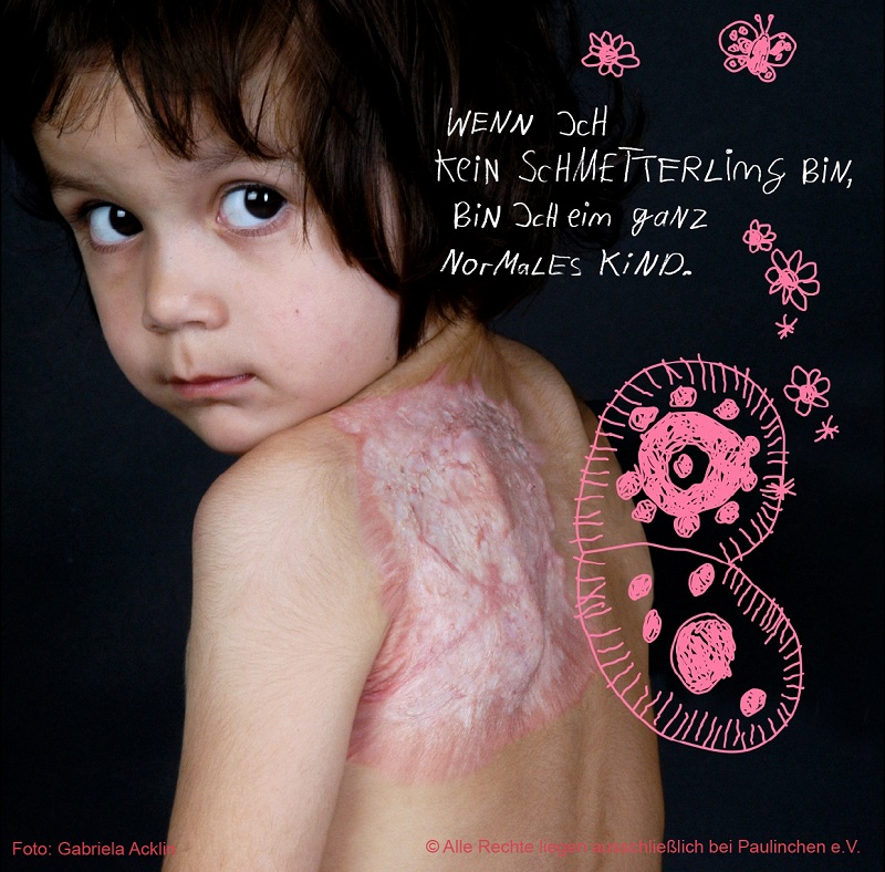 Tag des brandverletzten Kindes 2019